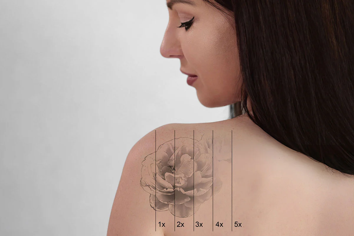 Tattoo and Pigmentation Removal