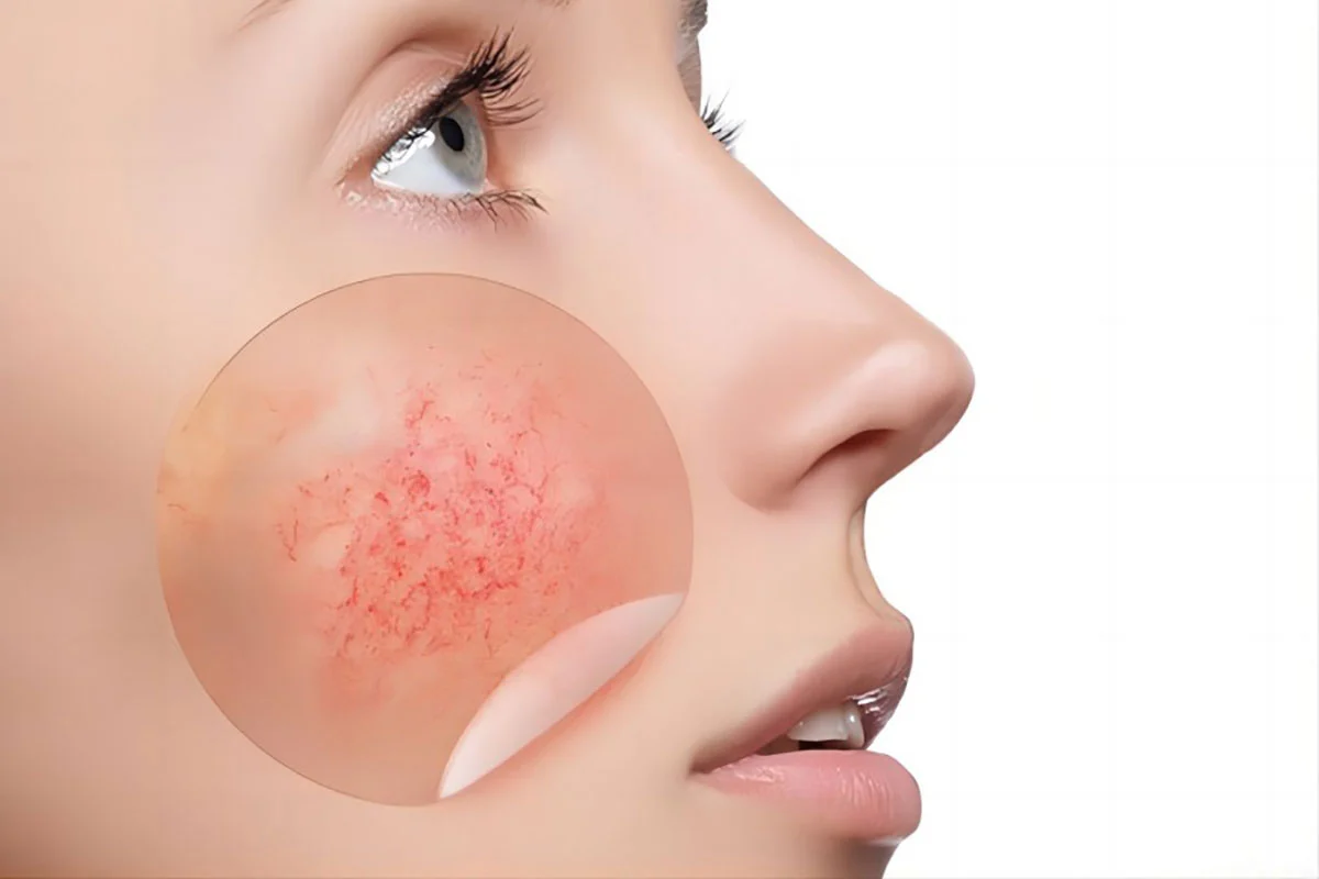 Vascular Removal 980